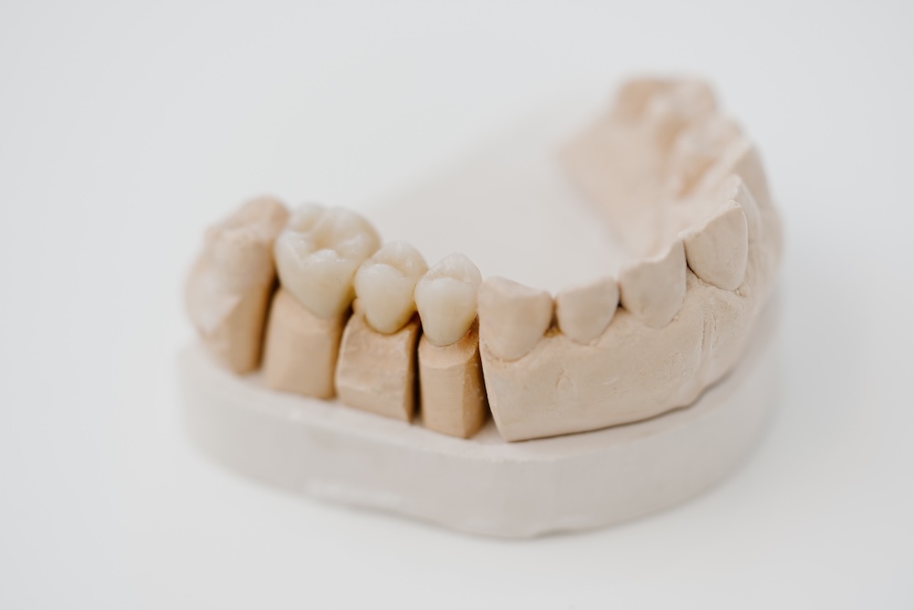 zahnarzt-bad-hindelang-zahnarztpraxis-am-hirschberg-zahnersatz